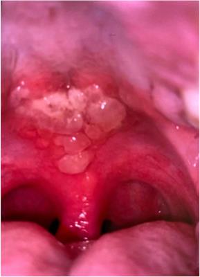 Painful ulcerations associated with COVID-19 in an adolescent patient: a case report